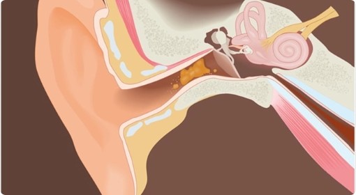 WHAT IS EARWAX?